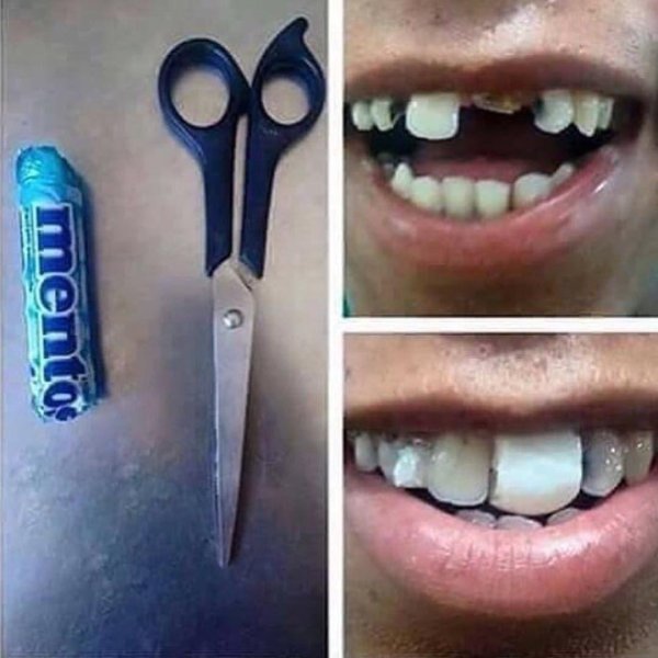 передние зубы