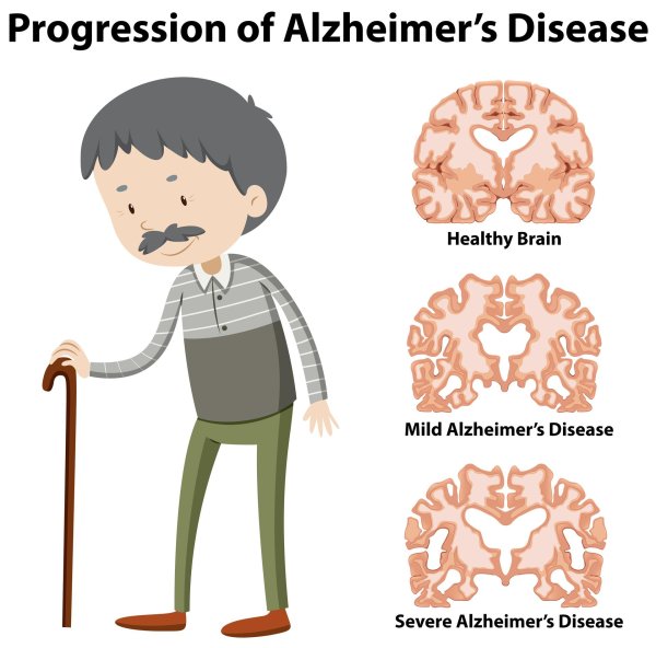 alzheimers disease