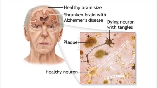 alzheimers disease