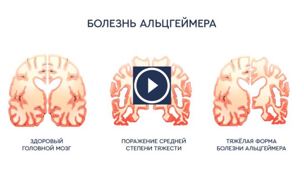 мозг при альцгеймере