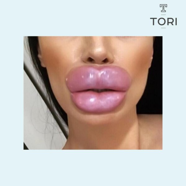 накачала губы