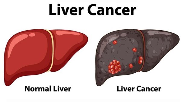 liver cancer