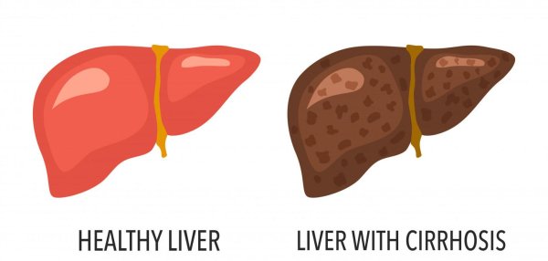 неалкогольный жировой гепатоз