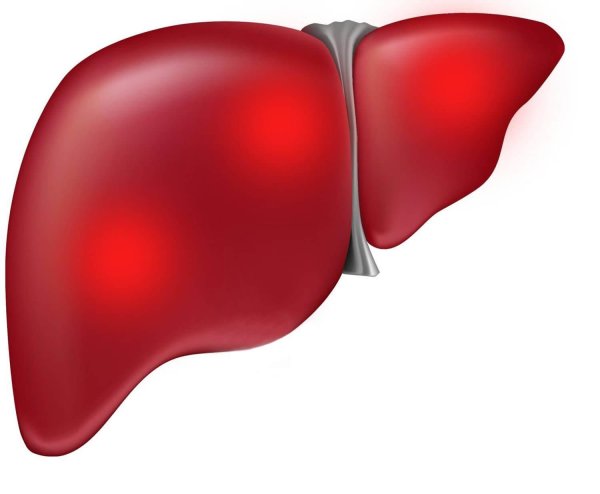 первичного билиарного цирроза печени