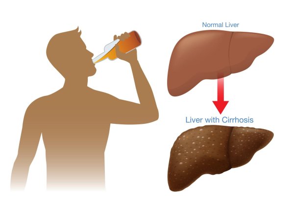 liver cirrhosis