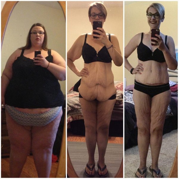 свисающая кожа после похудения