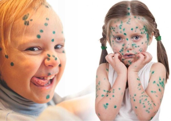 ветрянка зеленка