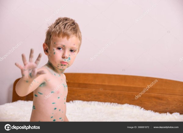 ветряная оспа