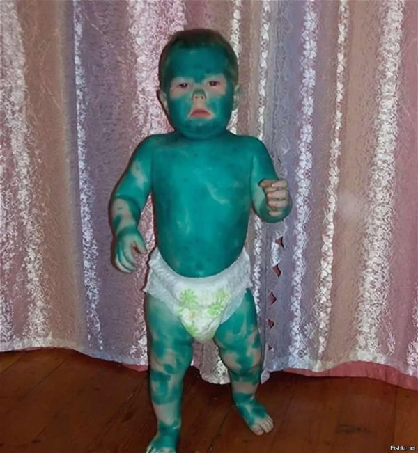 дети с ветрянкой в зеленке