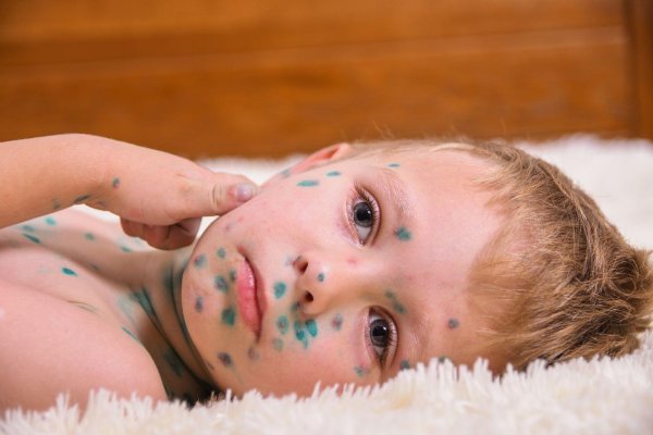 ветряная оспа