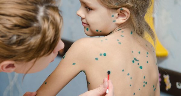 генерализированная ветрянка