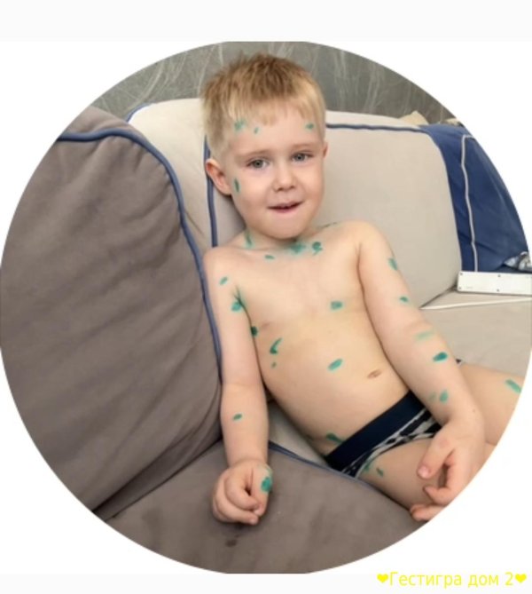 оспенная ветрянка