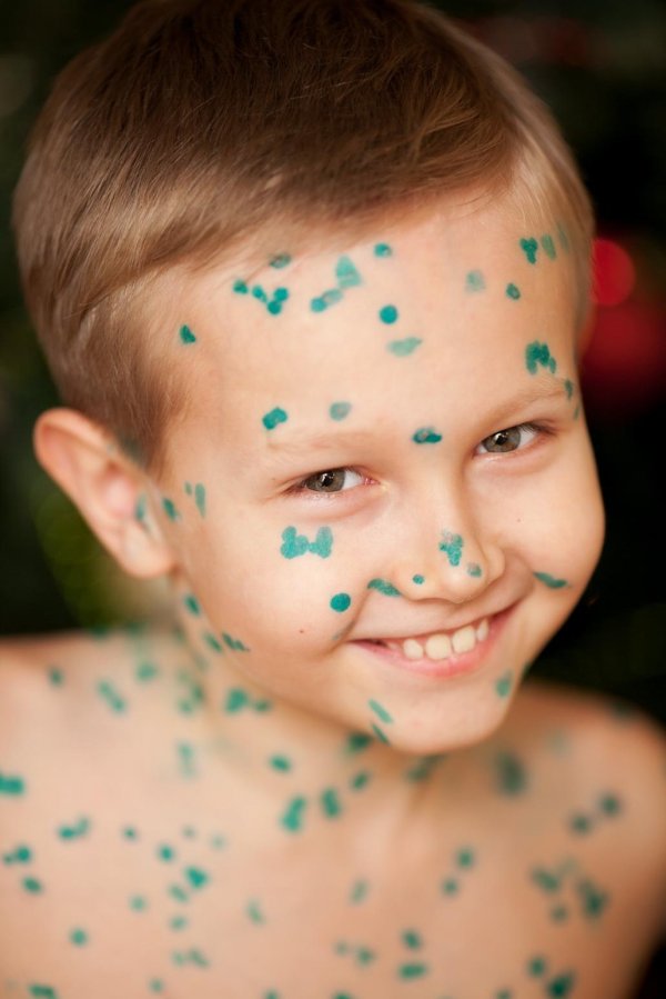 ветрянка папулы