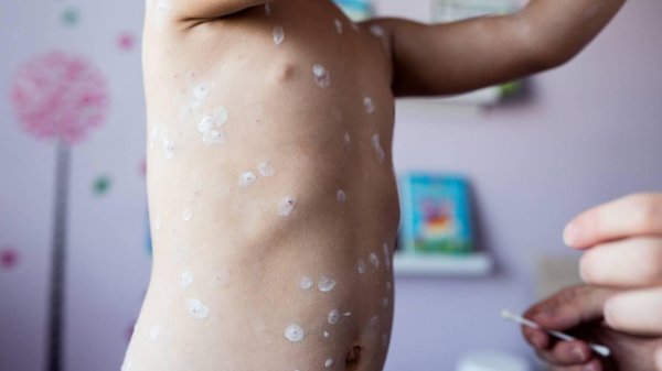 против ветрянки каламин