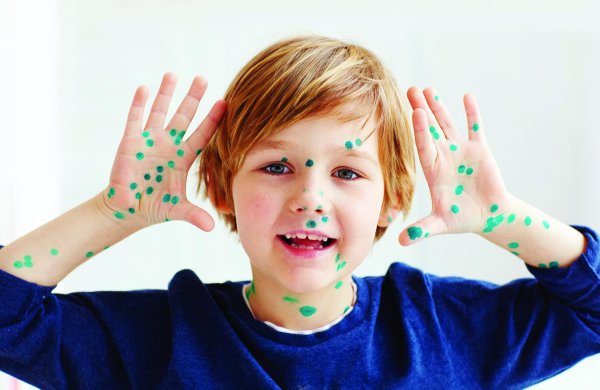 ветряная оспа