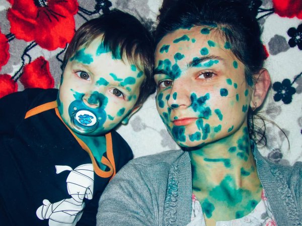 дети с ветрянкой в зеленке