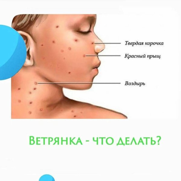 ветрянка типы