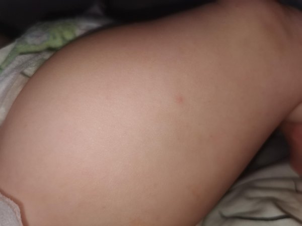 начало ветрянки