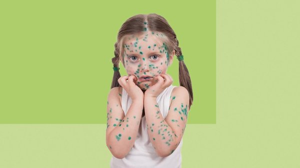 агравированная ветрянка