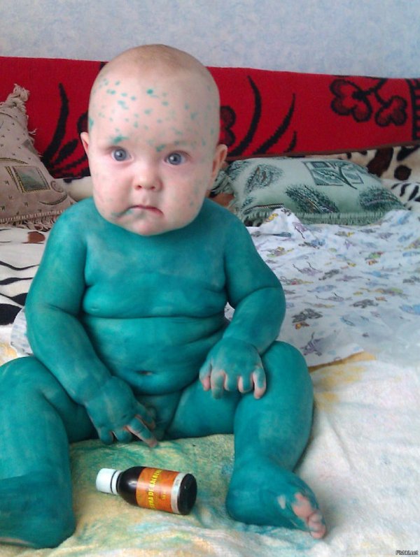 дети с ветрянкой в зеленке