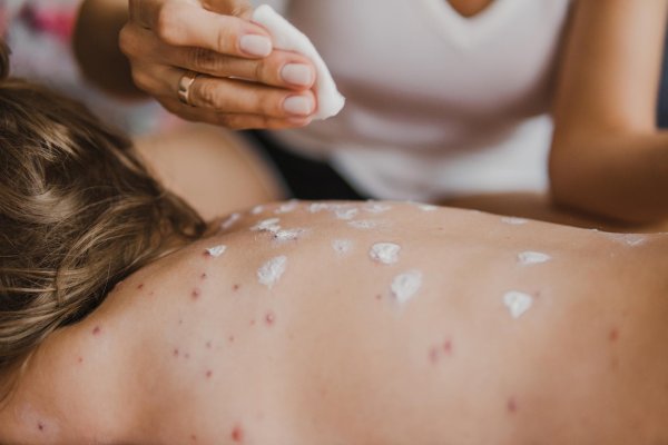 оспа ветряная