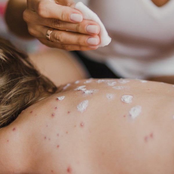 корь у детей симптомы