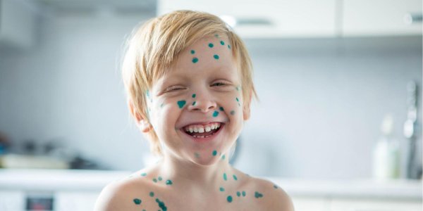 ветряная оспа