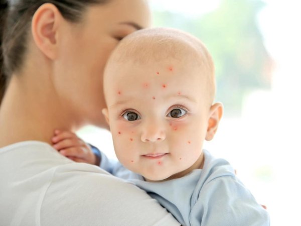 ветряная оспа