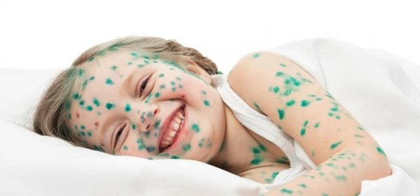 гангренозная ветрянка