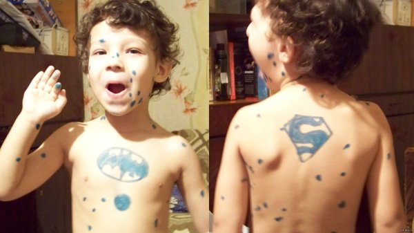 мазать ветрянку