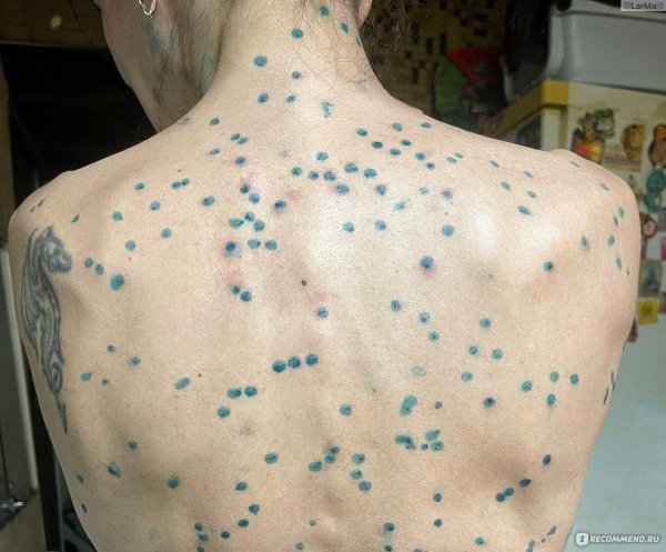 гангренозная ветрянка