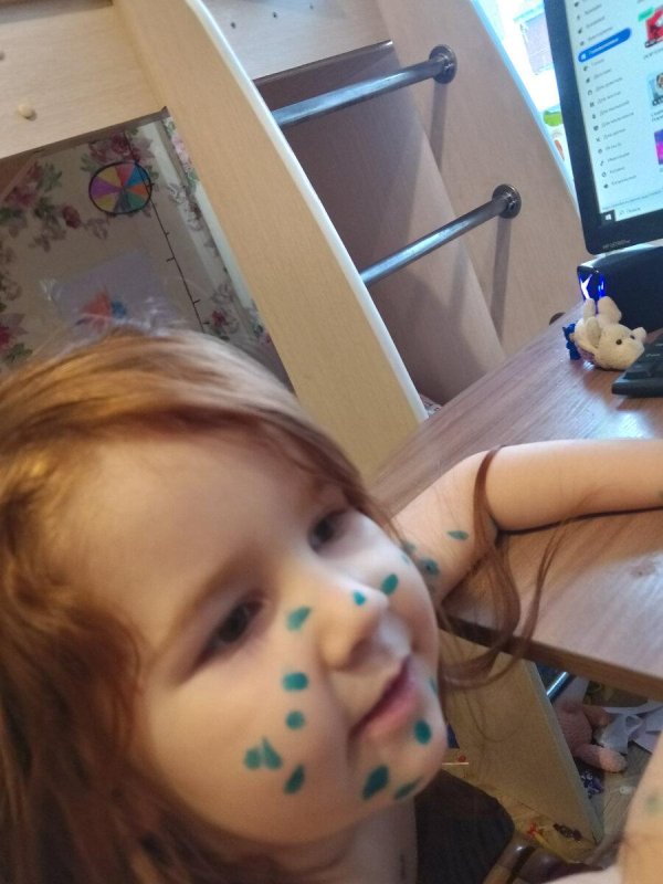 детская ветрянка