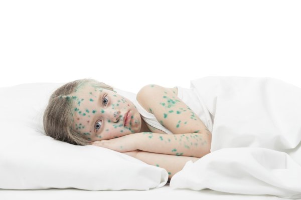 гангренозная ветрянка