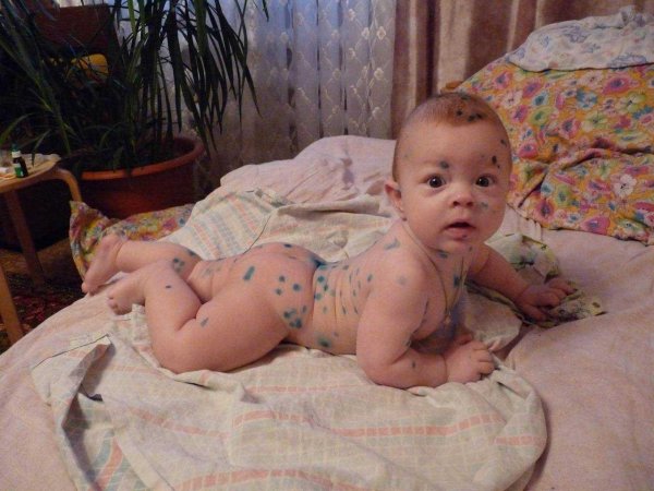 оспенная ветрянка