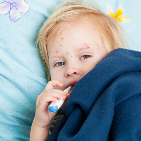 энтеровирусная пузырчатка