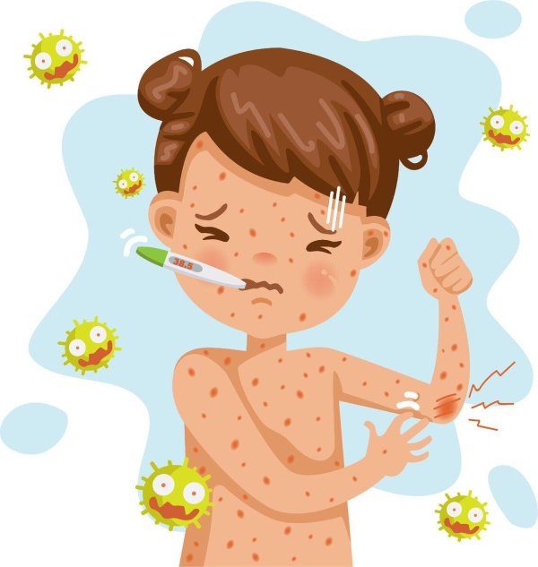 ветряная оспа