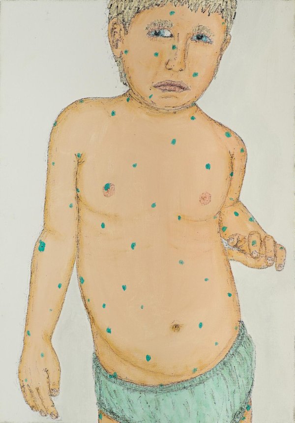 выглядит ветрянка