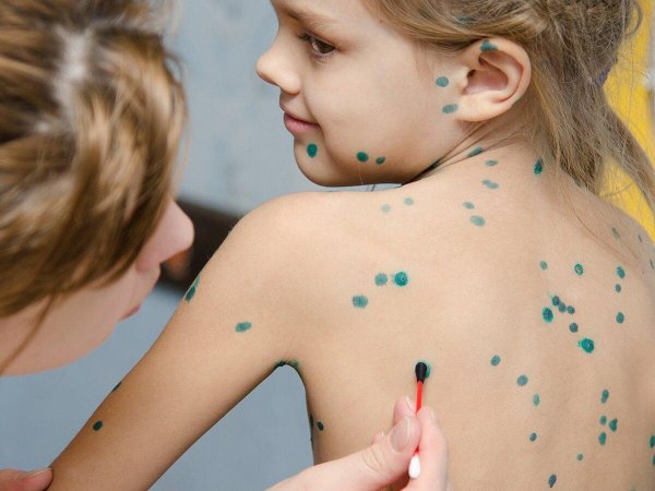 генерализированная ветрянка