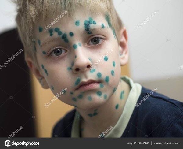 ветрянка детей