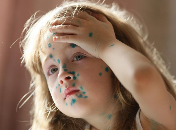 ветряная оспа