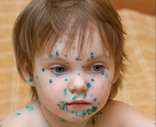 симптомы ветрянка