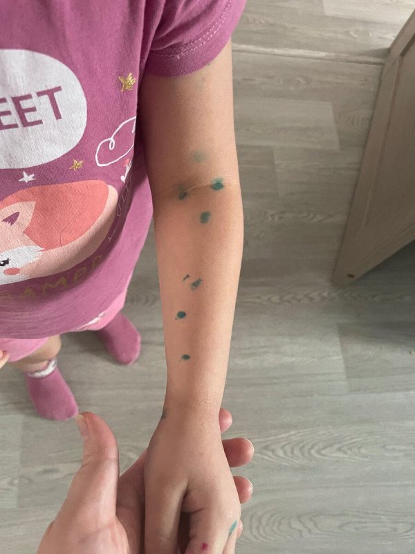 ветрянка зеленка