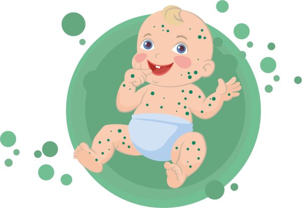 ветряная оспа