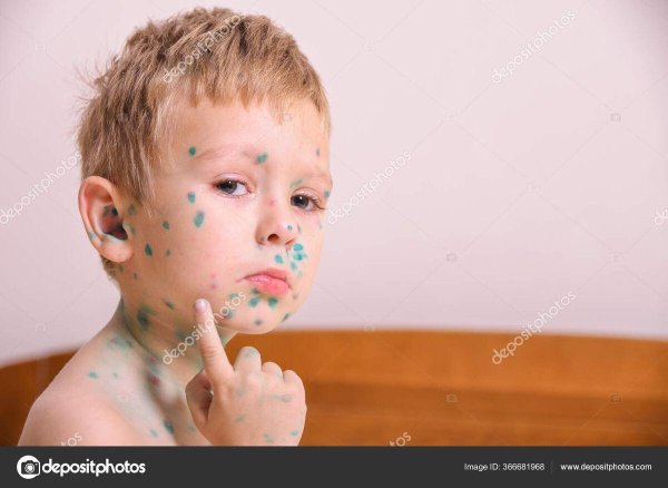 ветряная оспа