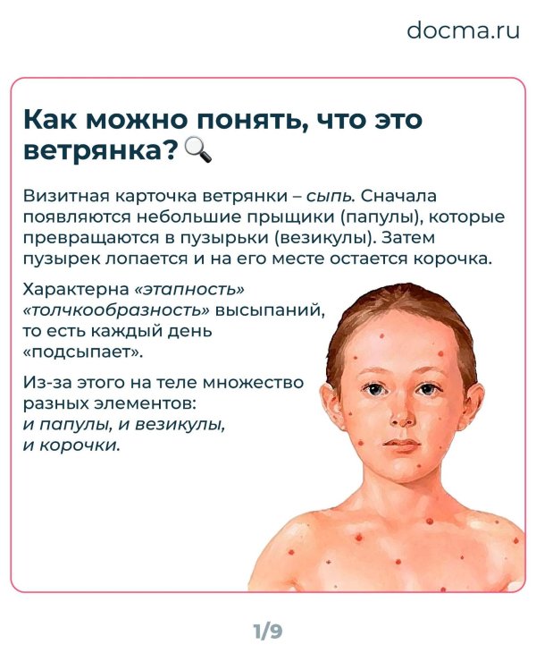 ветряная оспа