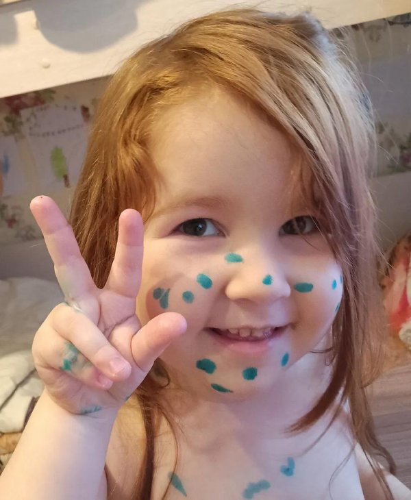 здравствуй ветрянка