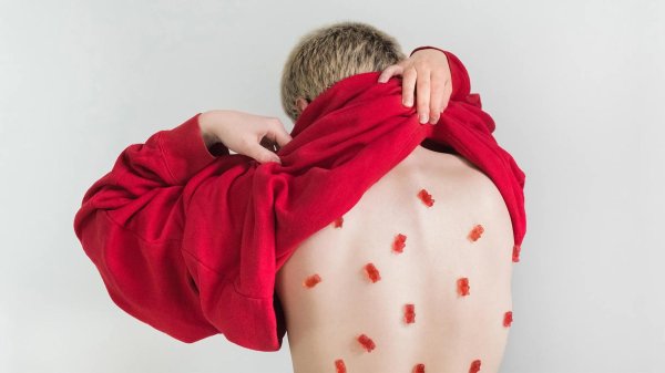 корь ветрянка