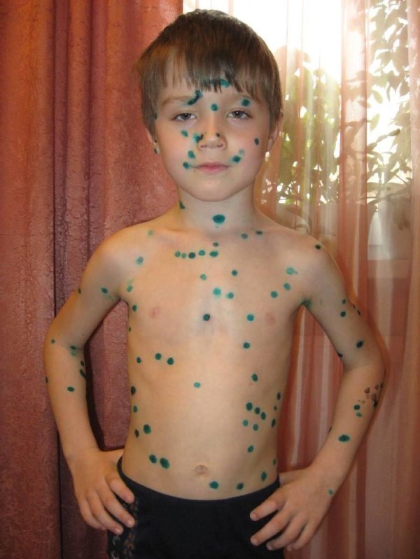 оспенная ветрянка