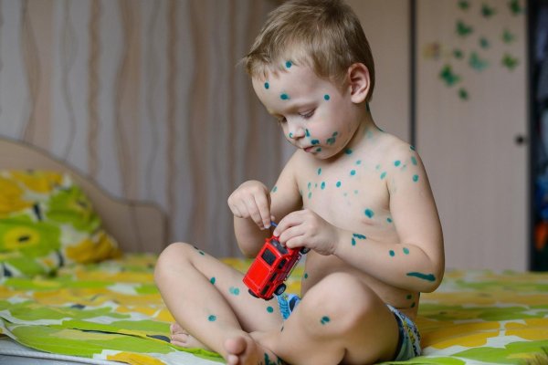 оспенная ветрянка