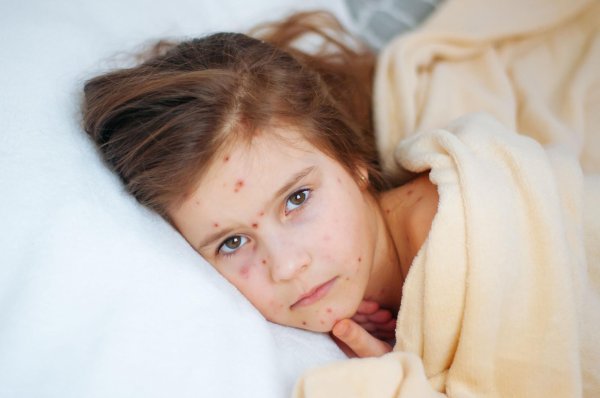 ветряная оспа